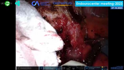 Попов С.В. - Робот-ассистированная нейросохраняющая радикальная простатэктомия (роботическая система da Vinci Xi)