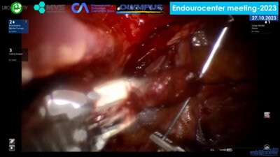 Гулиев Б.Г. - Робот-ассистированная аденомэктомия (роботическая система da Vinci Si)