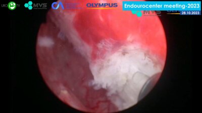 Бурлака О.О. - Гольмиевая лазерная энуклеация аденомы предстательной железы