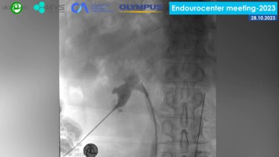 Ершов А.В. - Миниперкутанная нефролитотрипсия