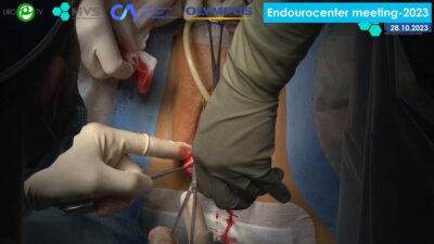 Кондратьев А.С. - Унилатеральная сакроспинальная гистеропексия с использованием синтетического эндопротеза