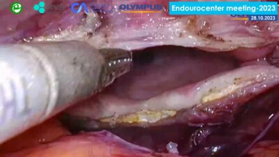 Помешкин Е.В. - Лапароскопическое устранение пузырно-влагалищного свища