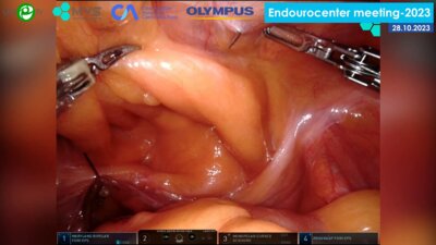 Сафиуллин Р.И. - Робот-ассистированная радикальная простатэктомия (техника с сохранением ретциева пространства da Vinci Xi)