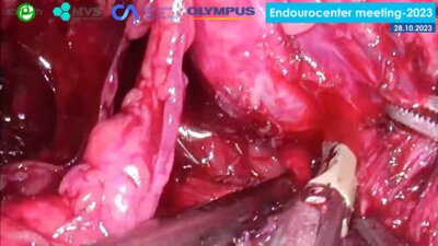 Сергеев В.П. - Лапароскопическая простатэктомия (унилатеральный доступ)