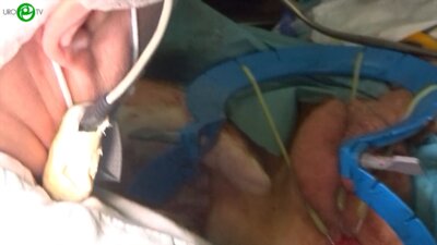 Еникеев М.Э. - Пластика уретро-ректального свища с использованием нежной мышцы бедра и превентивной деривацией мочи