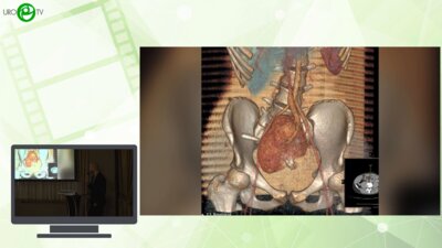 Каганцов И.М., Дубров В.И., Пелих К.И., Филиппов Д.В., Гурович А.О. - Реконструкция при критическом дефиците мочеточника единственной тазовой кости