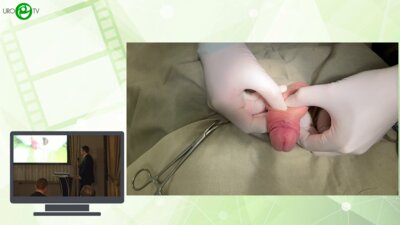 Кызласов П.С., Мустафаев А.Т., Абуев Г.Г., Боков А.И. - Корпоропластика у пациента с врожденным аномалиям полового члена