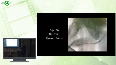 Мамаев И.Э. - Стриктура ладьевидной ямки, ventral inlay — это возможно