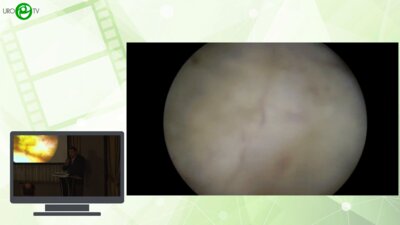 Андреев Р.Ю. - Оптимальная лазерная хирургия ДГПЖ