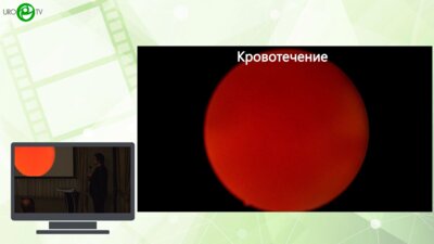 Петов В.С., Абдусаламов А.Ф., Еникеев, М.Э., Рапопорт Л.М. - Ошибки и осложнения лазерной энуклеации ДГПЖ