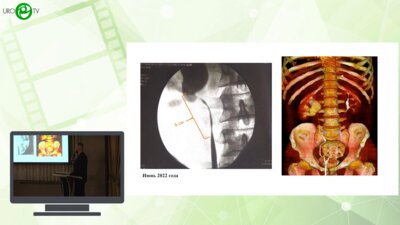 Витаев А.А. -  Робот-ассистированная аугментационная пластика лоханочно-мочеточникового сегмента и верхней трети правого мочеточника