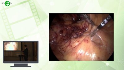 Мамаев И.Э., Ягудин Ш.Б. - Лапароскопическая пиелолитотомия при коралловидном нефролитиазе