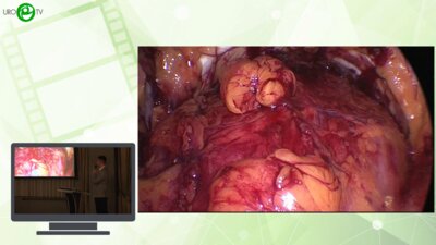 Проскоков А.А., Молчанов Ю.В., Климов Ю.А. - Лапароскопическая резекция дивертикула мочевого пузыря