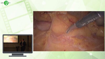 Рева С.А. - Повторная резекция почки при рецидиве после ранее перенесенного органосохраняющего лечения почечно-клеточного рака