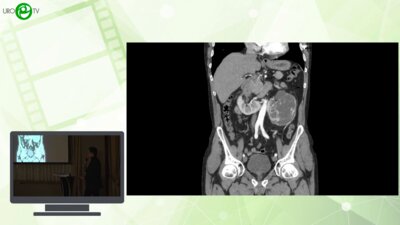 Святивода Р.В., Кудряшов О.И., Кузин Б.А. - Варианты лапароскопического доступа к почечным сосудам при крупных опухолях подковообразной почки