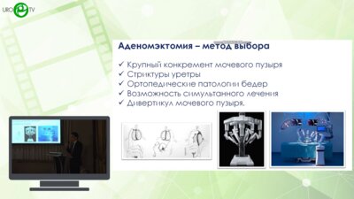 Тургуналиев С.А. - Робот-ассистированная аденомэктомия при гиперплазии простаты больших размеров
