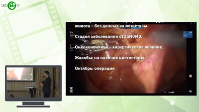 Ильин Д.М. - Робот-ассистированная радикальная простатэктомия у пациента с цистостомой