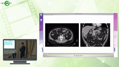 Караев Д.К., Саакян А.А., Фатихов Р.Р. - Лапароскопическая энуклеация опухоли левой почки RENAL 12 с использованием 3D-реконструкции