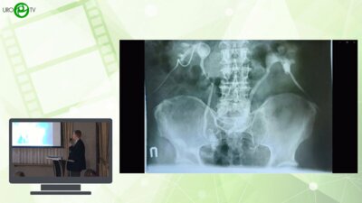 Перлин Д.В. - Лапароскопическая пластика при стриктуре анастомоза после операции Брикера