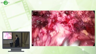 Петросян Г.С. - Лапароскопическая цистэктомия после перенесенной простатэктомии + ДЛТ с приключениями