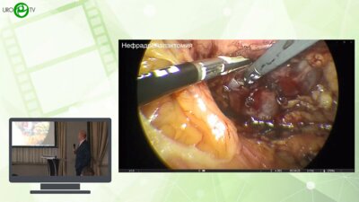 Сегедин Р.E., Святивода Р.В., Кудряшов О.И. - Сложные случаи лечения новообразований почек и надпочечников, наш опыт