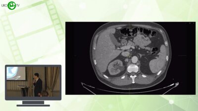 Соколов С.А. - Лапароскопичекая нефрэктомия с ретро и аортокавальной лимфаденэктомией
