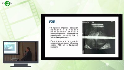 Каганцов И.М. - Разрыв опухоли Вильмса с тромбом нижней полой вены у ребенка 5 лет