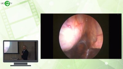 Каганцов И.М., Пелих К.И., Кондратьева Е.А. - Применение червеобразного отростка в детской урологии