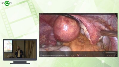 Оганес Э.Д. - Лапароскопическая декомпрессия пудендального нерва с установкой нейропротеза (процедура L.I.O.N.)