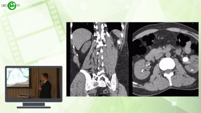 Петров А.Д. - Двусторонняя одноэтапная комбинированная ПНЛ слева и гибкая УРС справа при билатеральном нефролитиазе