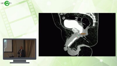 Шкодкин С.В. - Анастомотическая пластика задней уретры с адаптацией кавернозных тел