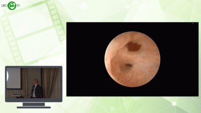 Шкодкин С.В. - Этапная пластика уретры - для кого?