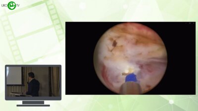 Гах Д.В. - Трансуретральная лазерная энуклеация гиперплазии предстательной железы после чреспузырной аденомжктомии и ТУР