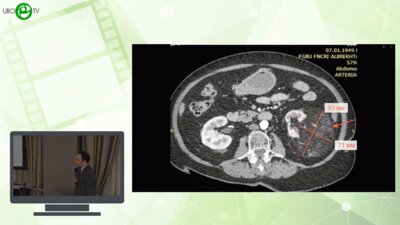 Перфильев М.А. - Эндоваскулярные подходы в лечении онкоурологических заболеваний