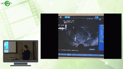 Симонович А.В. - Трансуретральная энуклеация аденомы простаты под УЗИ контролем