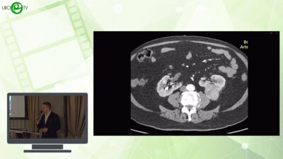 Фокин И.В. - Ретроперитонеоскопическая резекция подковообразной почки при раке