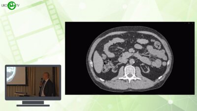 Шкодкин С.В. - Эндовезикальное дренирование. Лазерная инцизия стриктуры