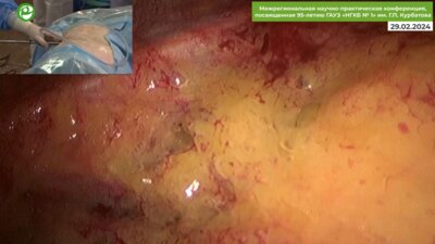 Ильинская Е.В. - Люмбоскопическая нефрэктомия