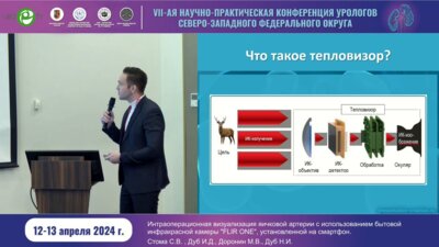 Стома С.В. - Интраоперационная визуализация яичковой артерии с использованием бытовой инфракрасной камеры FLIR ONE