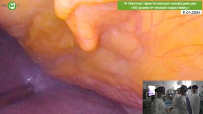 Сергеев В.П. - Olympus Visera Elite Лапароскопическая резекция правой почки