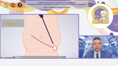 Tamer Wafa - Этапное лапароскопическая орхопексия при абдоминальном крипторхизме (техника Shehata)