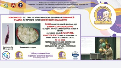 Пирогов А.В., Сизонов В.В, Коган М.И. - Ретроперитонеоскопическое удаление эхинококковой кисты левой почки у девочки 8 лет
