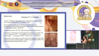 Пунтикова А.Ю. - Диагностика и лечение пациентов с нарушением формирования пола 46ХУ дисгенезией гонад