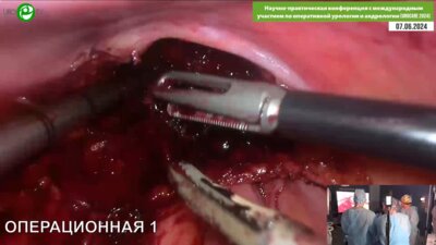 Мишугин С.В - Лапароскопическая цистпростатэктомия