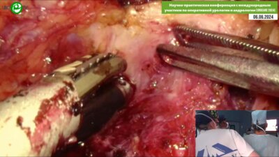 Галлямов Э.А. - Лапароскопическая нервосберегающая простатэктомия