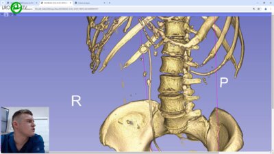 Еременко А.Н. - Уретрореноскопия справа. Трансуретральная контактная робот-ассистированная уретролитотрипсия справа
