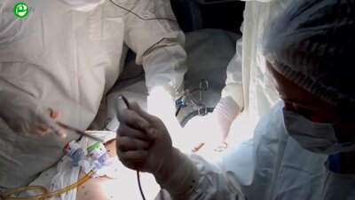 Еременко А.Н. - 3D ВЛС интерфасциальная нервосберегающая радикальная простатэктомия с реконструкцией уретры