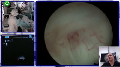 Еременко А.Н. - Трансуретральная лазерная энуклеация аденомы простаты под УЗИ-контролем