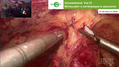Панфёров А.С., Стригунов А.А. - Лапароскопическая пластика мочеточника