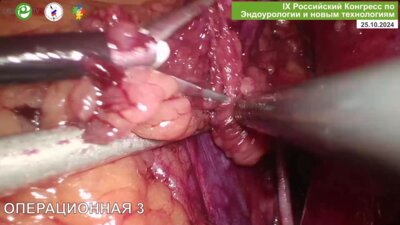 Кочкин А.Д. - Лапароскопическая радикальная простатэктомия